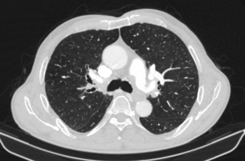 Chronic pulmonary embolism (Radiopaedia 91241-108843 Axial lung window 35).jpg