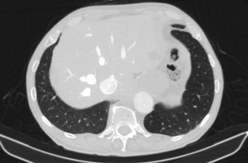 File:Chronic pulmonary embolism (Radiopaedia 91241-108843 Axial lung window 82).jpg