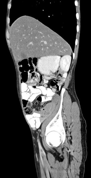 File:Chronic small bowel volvulus (Radiopaedia 75224-86322 C 111).jpg