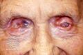 Cicatricial pemphigoid (DermNet NZ immune-cic-pem5).jpg