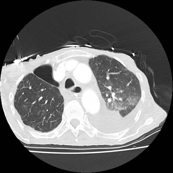 File:Clagett thoracotomy with bronchopleural fistula (Radiopaedia 29192-29587 Axial lung window 15).jpg