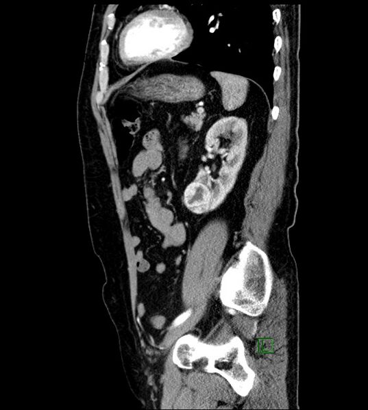 File:Clear cell renal cell carcinoma (Radiopaedia 85006-100539 E 18).jpg