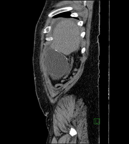 File:Closed-loop small bowel obstruction-internal hernia (Radiopaedia 78439-91096 C 126).jpg