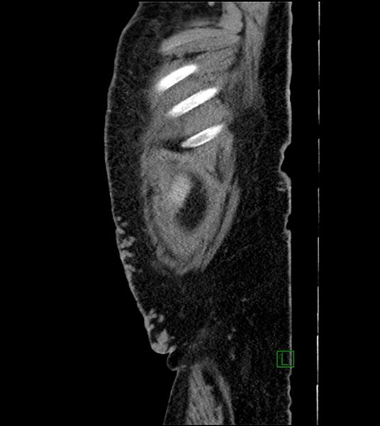 File:Closed-loop small bowel obstruction-internal hernia (Radiopaedia 78439-91096 C 17).jpg