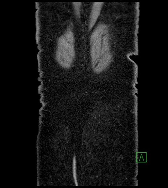 File:Closed-loop small bowel obstruction-internal hernia (Radiopaedia 78439-91096 Coronal non-contrast 100).jpg