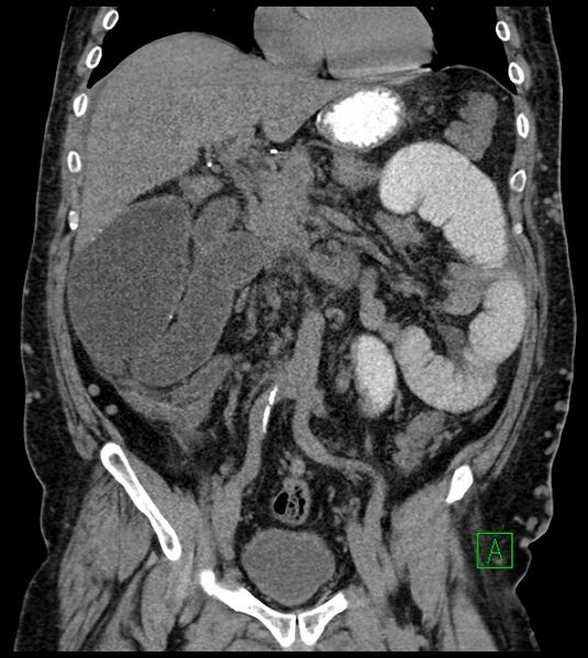 File:Closed-loop small bowel obstruction-internal hernia (Radiopaedia 78439-91096 Coronal non-contrast 48).jpg