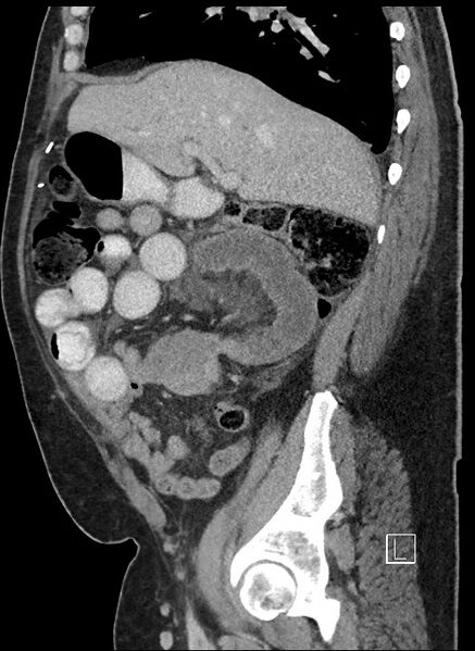 File:Closed loop obstruction - internal hernia into nephrectomy bed (Radiopaedia 59867-67320 C 69).jpg