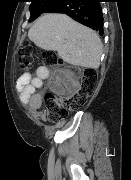 File:Closed loop obstruction - internal hernia into nephrectomy bed (Radiopaedia 59867-67320 C 84).jpg