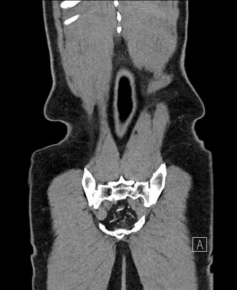 File:Closed loop small bowel obstruction - internal hernia (Radiopaedia 57806-64778 A 114).jpg