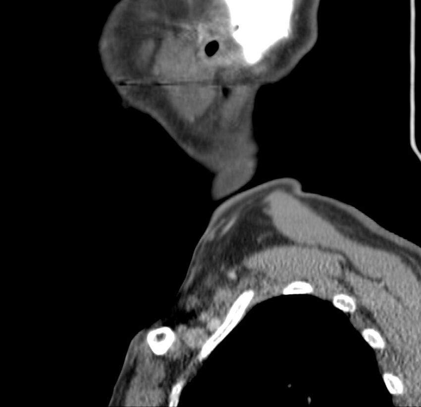 Colloid cyst of thyroid (Radiopaedia 22897-22923 Sagittal C+ delayed 8).jpg