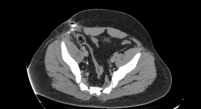 File:Colocutaneous fistula (Radiopaedia 56401-63062 Axial Fistulography 44).jpg