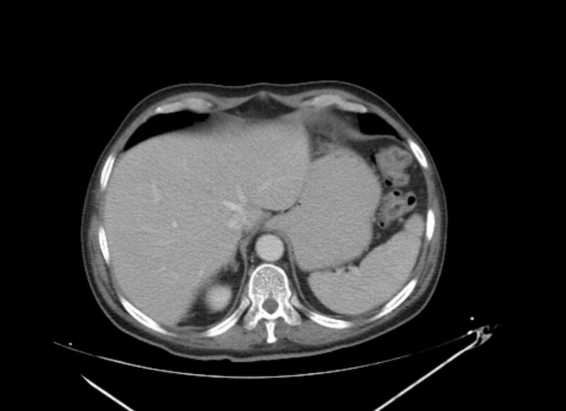 File:Colon cancer mimicking renal cell carcinoma (Radiopaedia 28986-29335 C 11).jpg