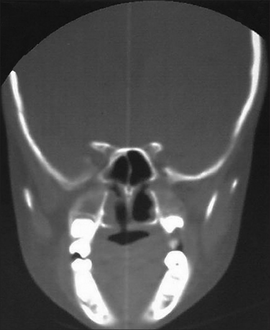 CT PNS showing the perforation of right side of hard palate