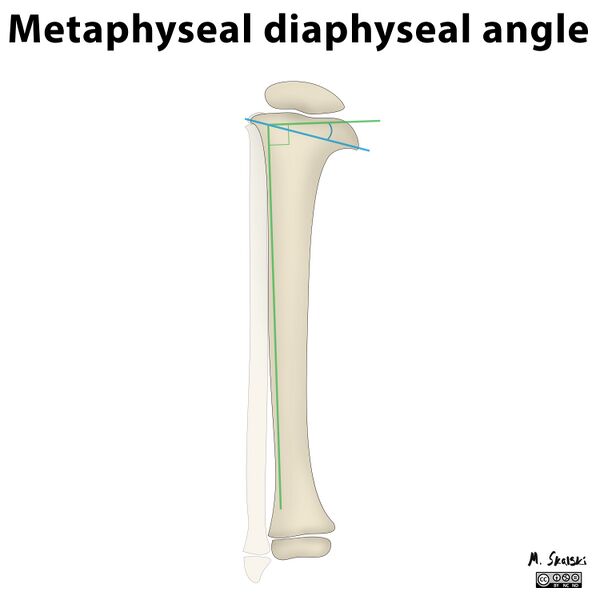 File:Diagram - Metaphyseal diaphyseal angle of Drennan (Radiopaedia 23625).jpg