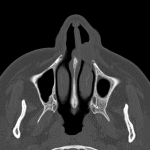 File:Nasolabial cyst (Radiopaedia 33987-35205 Axial bone window 10).jpg