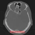 Nasopharyngeal carcinoma recurrence - skull base destruction (Radiopaedia 29107-29490 Axial bone window 70).jpg