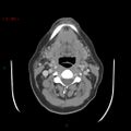 Nasopharyngeal lymphoma (Radiopaedia 54235-60433 A 15).jpg