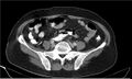 Necrotizing pancreatitis (Radiopaedia 20595-20495 A 31).jpg