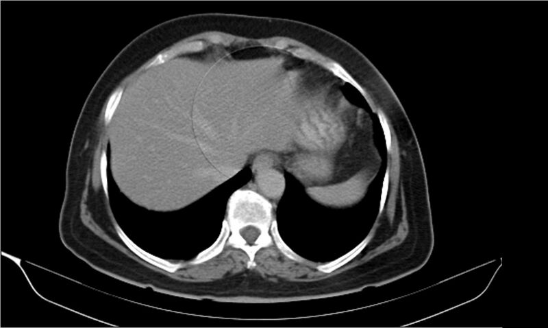 File:Necrotizing pancreatitis (Radiopaedia 20595-20495 Axial C+ delayed 3).jpg