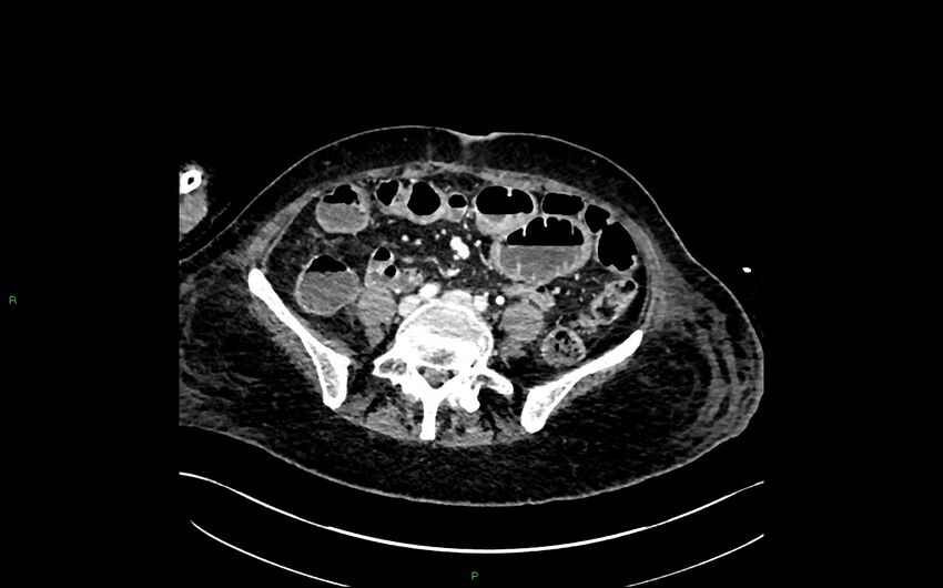 Neo-terminal ileal stricture (Crohn disease) (Radiopaedia 33790-34948 A 297).jpg