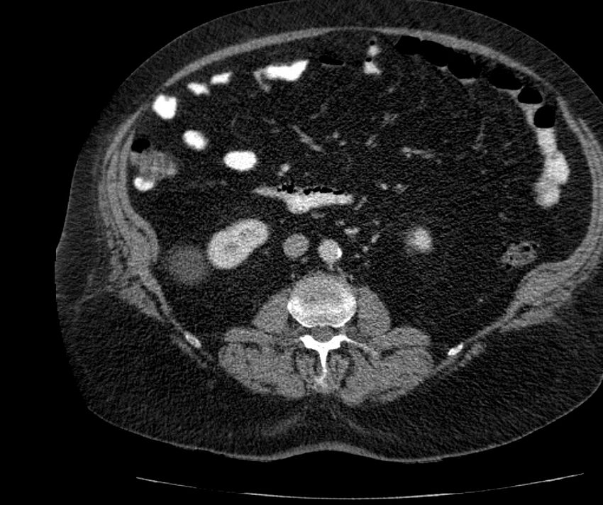 Nephroptosis with inguinal hernia containing perirenal fat (Radiopaedia 56632-63391 C 170).jpg