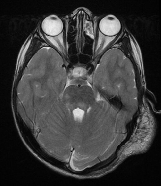 File:Neurofibromatosis type 1 (Radiopaedia 6954-8063 Axial T2 4).jpg