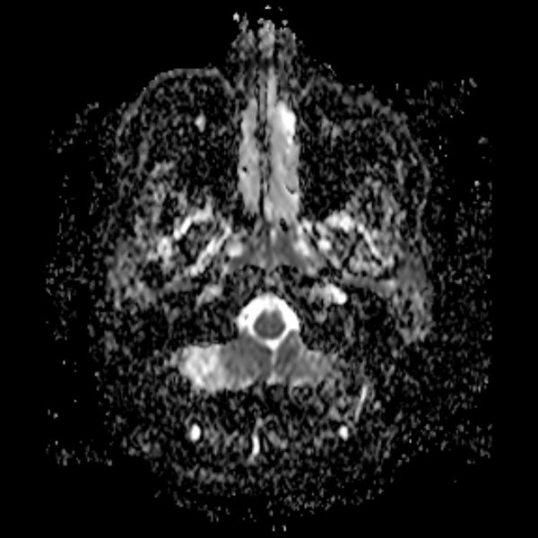 File:Neurofibromatosis type 2 (Radiopaedia 67470-76871 Axial ADC 2).jpg