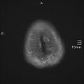 Neurotoxoplasmosis - concentric target sign (Radiopaedia 70644-80784 Axial FLAIR 22).jpg