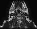 Non-Hodgkin lymphoma - parotid gland (Radiopaedia 71531-81890 Axial T2 4).jpg