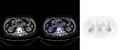 Non-Hodgkin lymphoma involving seminal vesicles with development of interstitial pneumonitis during Rituximab therapy (Radiopaedia 32703-33752 ax CT Fus PET 40).jpg