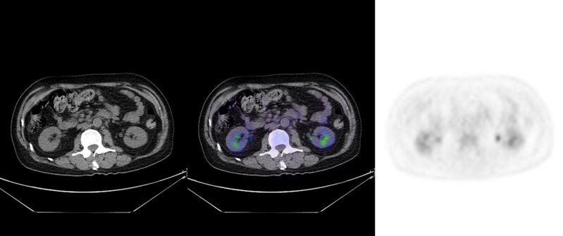 File:Non-Hodgkin lymphoma involving seminal vesicles with development of interstitial pneumonitis during Rituximab therapy (Radiopaedia 32703-33752 ax CT Fus PET 40).jpg