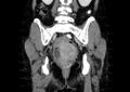 Non-puerperal uterine inversion (Radiopaedia 78343-91094 B 39).jpg