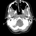 Normal CT of the neck (Radiopaedia 14575-14500 Axial C+ 16).jpg