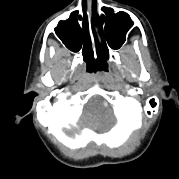 File:Normal CT of the neck (Radiopaedia 14575-14500 Axial C+ 16).jpg