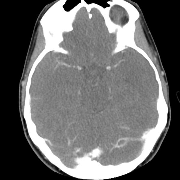 File:Normal CT of the neck (Radiopaedia 14575-14500 Axial C+ 3).jpg