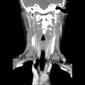 Normal CT of the neck (Radiopaedia 14575-14500 Coronal C+ 29).jpg