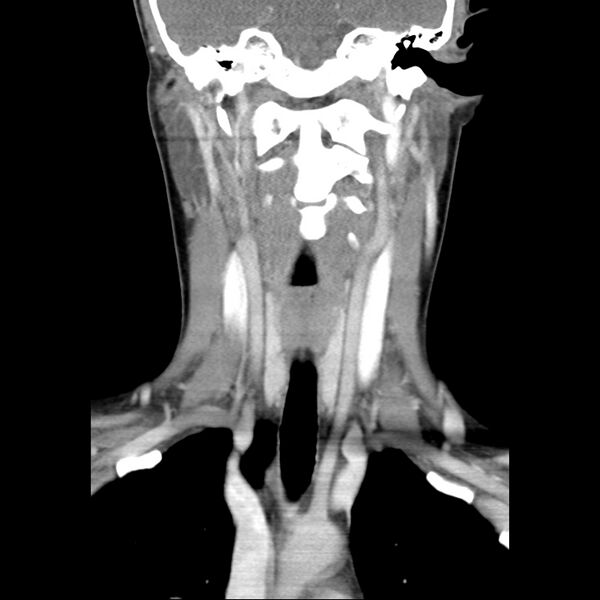 File:Normal CT of the neck (Radiopaedia 14575-14500 Coronal C+ 29).jpg