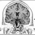 Normal coronal brain (Radiopaedia 6676-7910 B 19).jpg