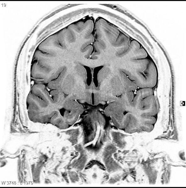 File:Normal coronal brain (Radiopaedia 6676-7910 B 19).jpg