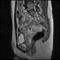 Normal female pelvis MRI (retroverted uterus) (Radiopaedia 61832-69933 Sagittal T2 14).jpg