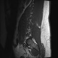 Normal lumbar spine MRI (Radiopaedia 47857-52609 Sagittal T1 1).jpg