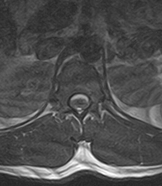 File:Normal lumbar spine MRI - low-field MRI scanner (Radiopaedia 40976-43699 Axial T2 10).jpg