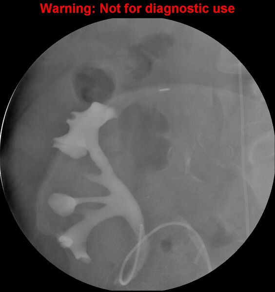 File:Normal retrograde pyelography of a native and transplant kidney (Radiopaedia 40480-43054 Transplant kidney 18).jpg