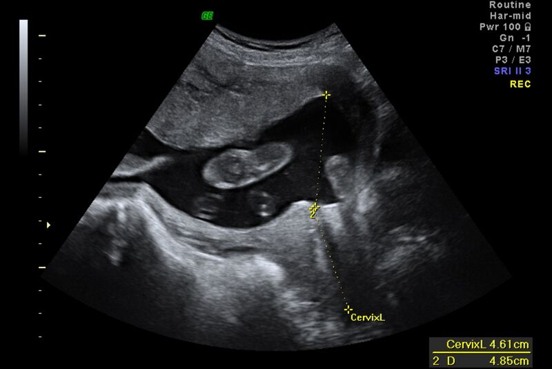 File:Normal second trimester ultrasound (Radiopaedia 44795).jpg