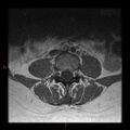 Normal spine MRI (Radiopaedia 77323-89408 Axial T1 12).jpg