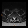 Normal spine MRI (Radiopaedia 77323-89408 Axial T2 26).jpg