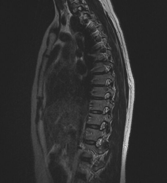 File:Normal thoracic spine MRI (Radiopaedia 41033-43781 Sagittal T2 4).jpg