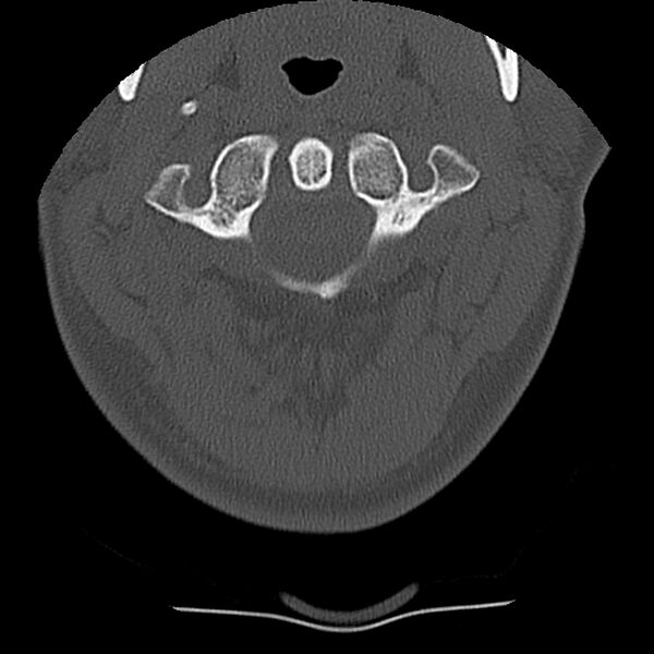File:Normal trauma spine imaging (Radiopaedia 31753-32686 Axial bone window 11).jpg