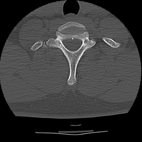 File:Normal trauma spine imaging (Radiopaedia 31753-32686 Axial bone window 72).jpg
