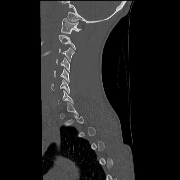 File:Normal trauma spine imaging (age 16) (Radiopaedia 45335-49358 Sagittal bone window 30).jpg